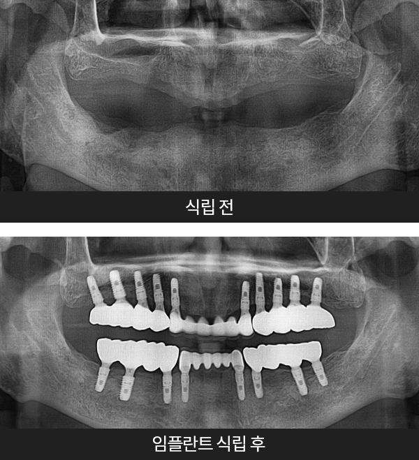 임플란트사례1