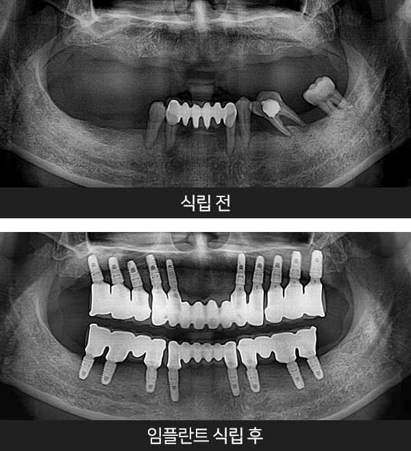 임플란트사례2