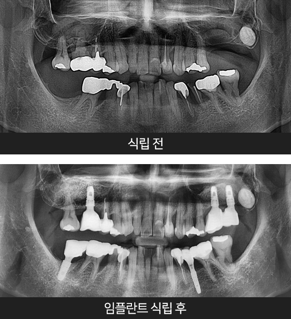 임플란트사례2