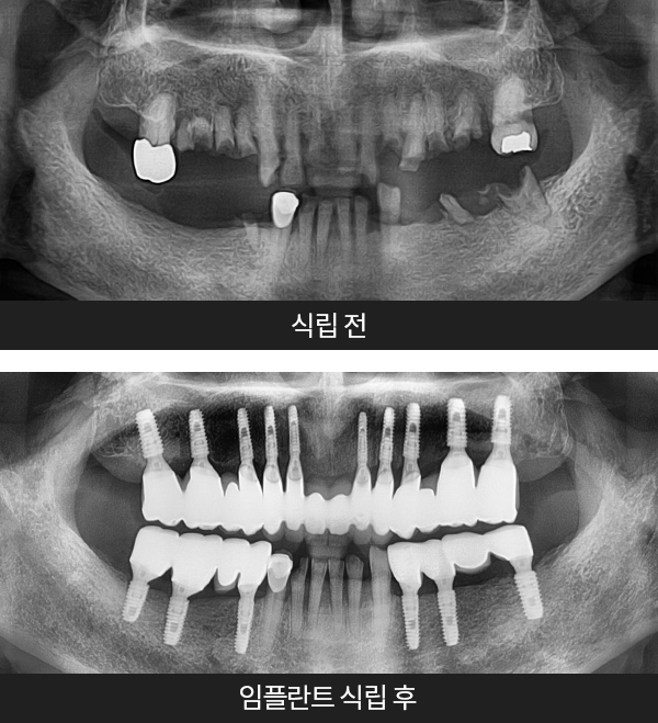 임플란트사례1