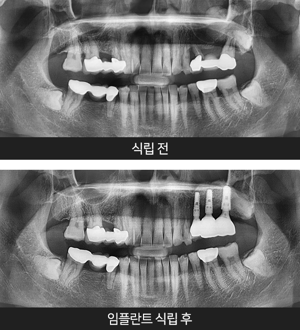 임플란트사례3