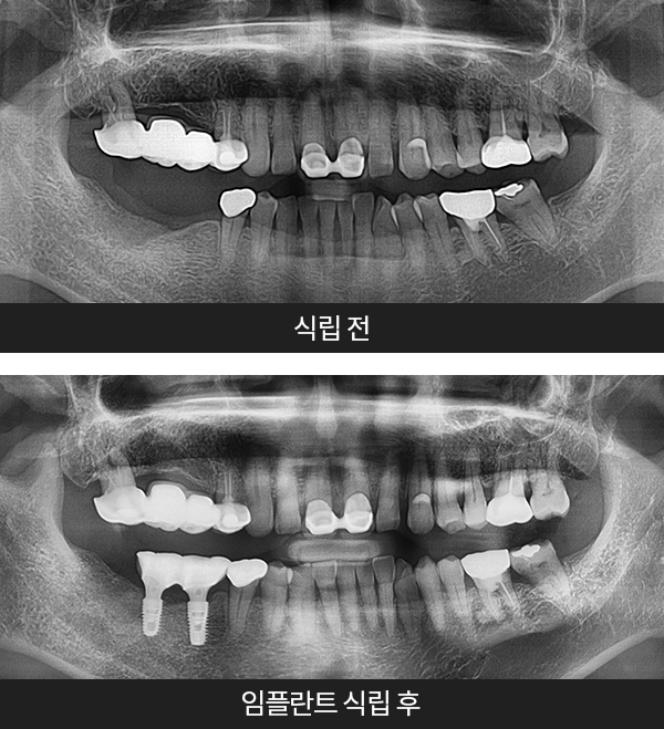 임플란트사례1