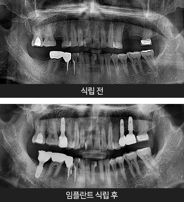 임플란트사례2