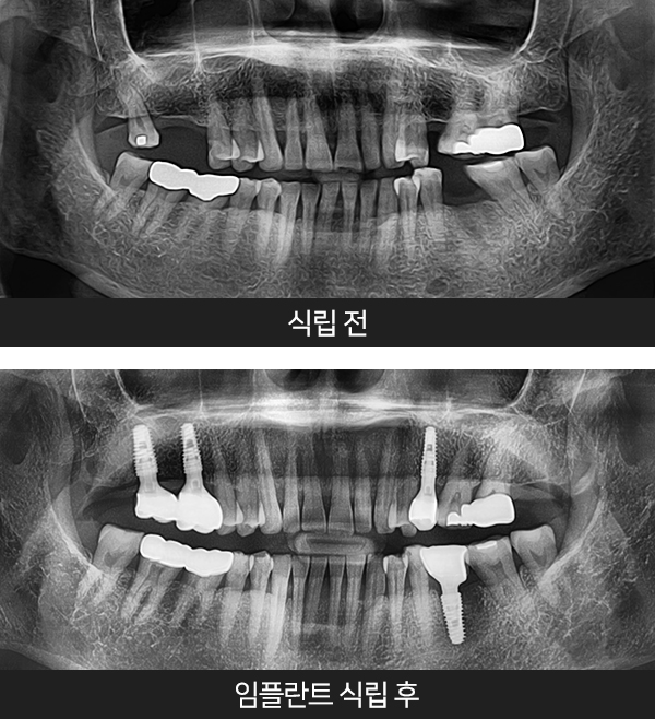 임플란트사례3