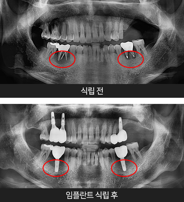 임플란트사례3
